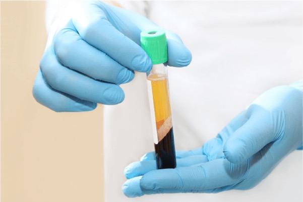 PRP(血小板)を抽出