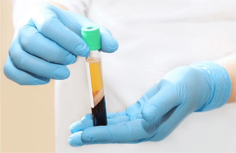 PRP(多血小板血漿)とは